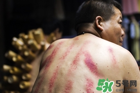 背部刮痧后能拔火罐嗎？背部刮痧后拔火罐有什么好處？