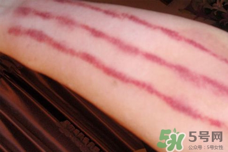 揪痧和刮痧哪個效果比較好？揪痧和刮痧的區(qū)別？