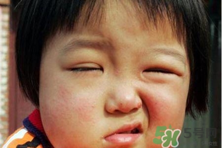 如何預(yù)防面癱復(fù)發(fā)？導(dǎo)致面癱的四大原因