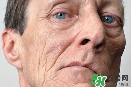 老年人為什么容易得面癱？老年人面癱原因有哪些？