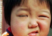 如何預防面癱復發(fā)？導致面癱的四大原因
