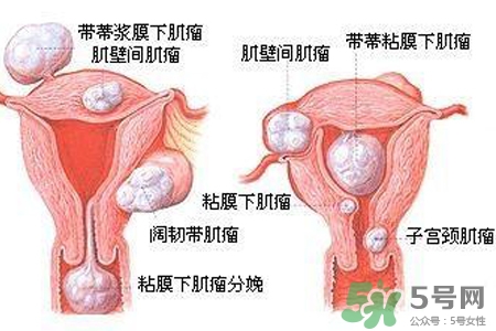 子宮小會影響生育嗎？子宮小會導(dǎo)致不孕嗎？