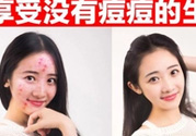 伊詩(shī)蘭頓祛痘怎么樣？伊詩(shī)蘭頓祛痘膏有用嗎？