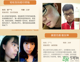 芷軒堂祛痘有效果嗎？芷軒堂祛痘印效果怎么樣？