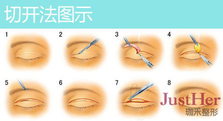 定點(diǎn)雙眼皮怎么做？定點(diǎn)雙眼皮需要拆線嗎？