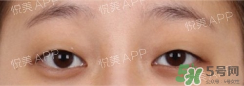 埋線雙眼皮多久恢復自然？埋線雙眼皮多久能恢復