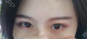 定點雙眼皮能保持多久？定點雙眼皮是永久的嗎？