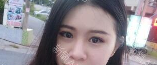 定點雙眼皮能保持多久？定點雙眼皮是永久的嗎？