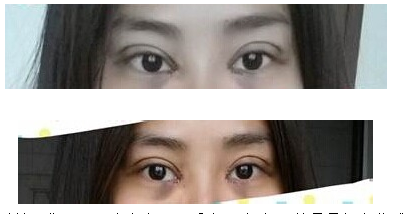 定點(diǎn)雙眼皮怎么做？定點(diǎn)雙眼皮需要拆線嗎？