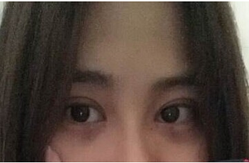 定點(diǎn)雙眼皮怎么做？定點(diǎn)雙眼皮需要拆線嗎？
