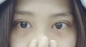 定點(diǎn)雙眼皮怎么做？定點(diǎn)雙眼皮需要拆線嗎？