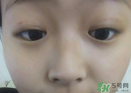埋線雙眼皮需要拆線嗎？埋線雙眼皮怎么拆線
