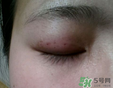 埋線雙眼皮需要拆線嗎？埋線雙眼皮怎么拆線