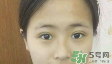 埋線雙眼皮需要拆線嗎？埋線雙眼皮怎么拆線