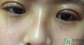 埋線雙眼皮需要拆線嗎？埋線雙眼皮怎么拆線