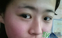 埋線雙眼皮需要拆線嗎？埋線雙眼皮怎么拆線