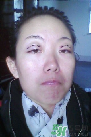 什么是定點(diǎn)雙眼皮？定點(diǎn)雙眼皮多少錢(qián)？