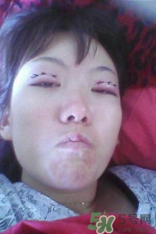 什么是定點(diǎn)雙眼皮？定點(diǎn)雙眼皮多少錢(qián)？