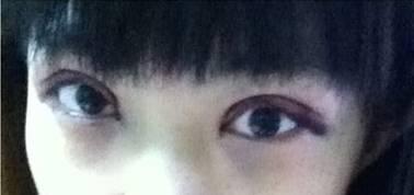韓式三點雙眼皮是永久嗎？三點雙眼皮能保持多久？