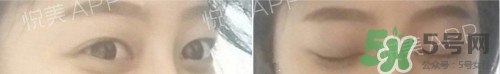 埋線雙眼皮多久恢復自然？埋線雙眼皮多久能恢復