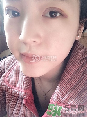 什么是定點(diǎn)雙眼皮？定點(diǎn)雙眼皮多少錢(qián)？