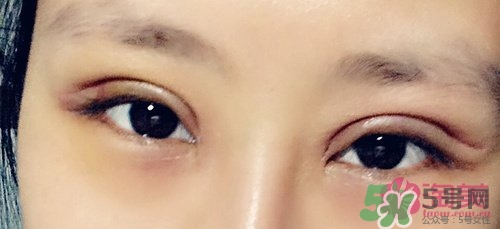 切開(kāi)雙眼皮多久消腫？切開(kāi)雙眼皮多久恢復(fù)？