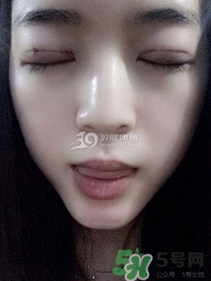 什么是定點(diǎn)雙眼皮？定點(diǎn)雙眼皮多少錢(qián)？