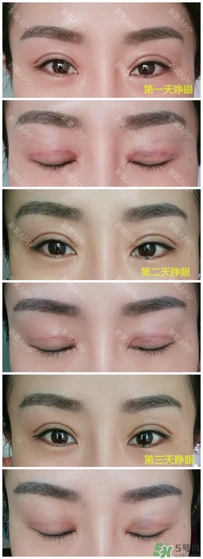 埋線雙眼皮能保持多久？埋線雙眼皮是永久嗎