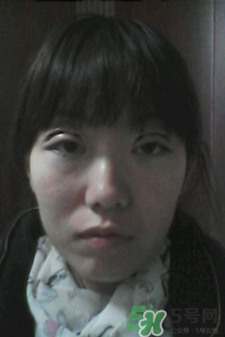什么是定點(diǎn)雙眼皮？定點(diǎn)雙眼皮多少錢(qián)？