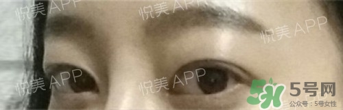 埋線雙眼皮多久恢復自然？埋線雙眼皮多久能恢復