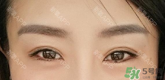 埋線雙眼皮能保持多久？埋線雙眼皮是永久嗎