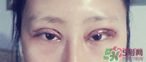 切開(kāi)雙眼皮多久消腫？切開(kāi)雙眼皮多久恢復(fù)？