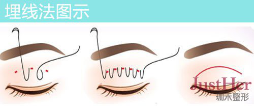 定點(diǎn)雙眼皮怎么做？定點(diǎn)雙眼皮需要拆線嗎？