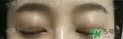 埋線雙眼皮多久恢復自然？埋線雙眼皮多久能恢復