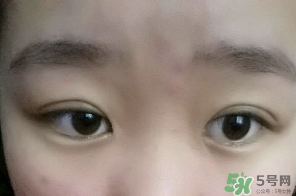 埋線雙眼皮需要拆線嗎？埋線雙眼皮怎么拆線