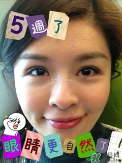 重瞼術(shù)是什么？重瞼術(shù)是永久的嗎？
