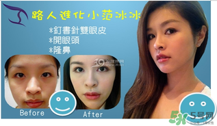 重瞼術(shù)是什么？重瞼術(shù)是永久的嗎？