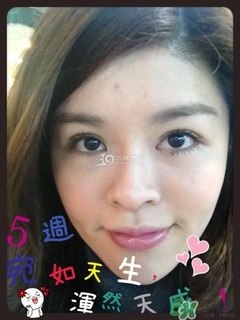 重瞼術(shù)是什么？重瞼術(shù)是永久的嗎？