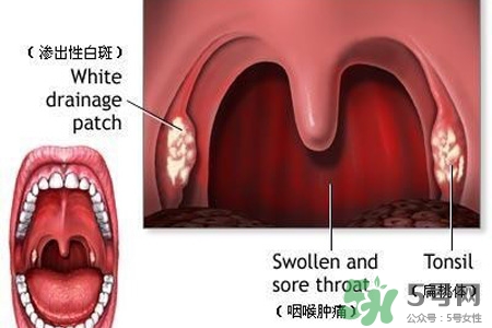 霧霾天喉嚨痛怎么辦？霧霾天嗓子疼怎么辦？