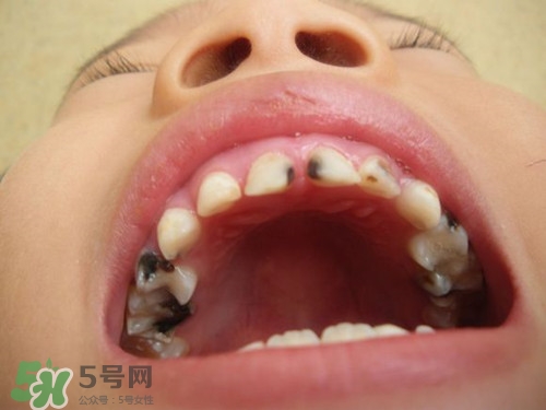 小孩換牙半年還沒長出來是怎么回事?小孩換牙注意事項(xiàng)