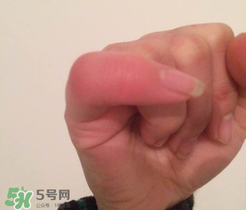 小拇指凍腫了怎么辦？為什么小拇指容易凍？