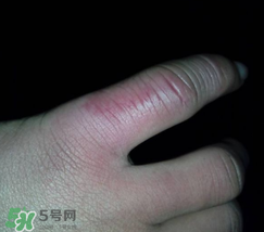 小拇指凍腫了怎么辦？為什么小拇指容易凍？