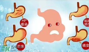神經(jīng)性胃痙攣是什么？神經(jīng)性胃痙攣是什么原因？