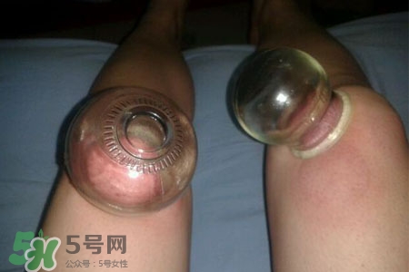 小腿能拔罐嗎？在小腿上拔火罐有什么作用？