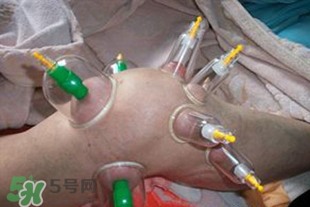小腿能拔罐嗎？在小腿上拔火罐有什么作用？