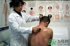 刮痧可以減肥嗎？刮痧減肥有效果嗎？