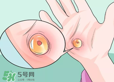 水泡怎么處理？水泡要不要刺破？