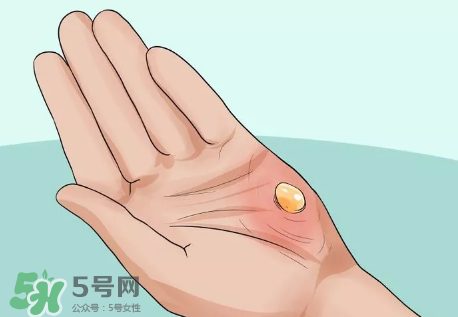 水泡怎么處理？水泡要不要刺破？
