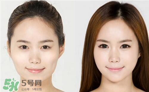 瘦臉針分為幾種類型？瘦臉針有哪幾個(gè)牌子？