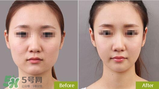 瘦臉針分為幾種類型？瘦臉針有哪幾個(gè)牌子？